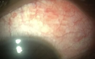 pinkeye_shakthieyecare2