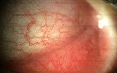 pinkeye_shakthieyecare3