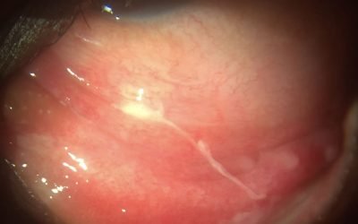 pinkeye_shakthieyecare4